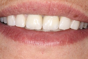 j allergn a fogszatban: a titnium