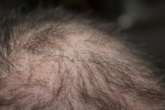 Autoimmun betegsget jelezhet, ha foltokban hullik a hajunk