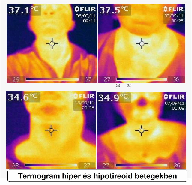 Termogram hiper- és hipotireoid állapotban