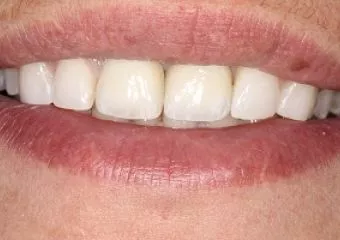 A fogakat felnőttként is érdemes szabályozni
