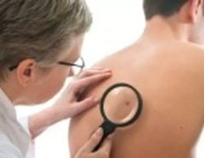 A férfiaknál veszélyesebb a melanoma 