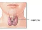 A pajzsmirigy és fontosabb betegségei