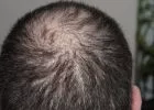 Milyen mértékű hajhullás normális? 