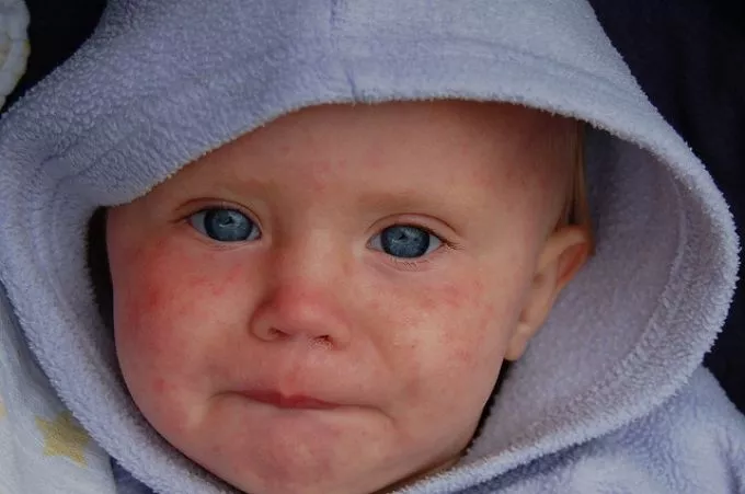 Pöttyök a baba arcán: tejkiütés vagy tejallergia?