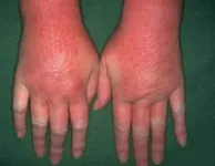 Allergiás bőrbetegségek - ekcéma
